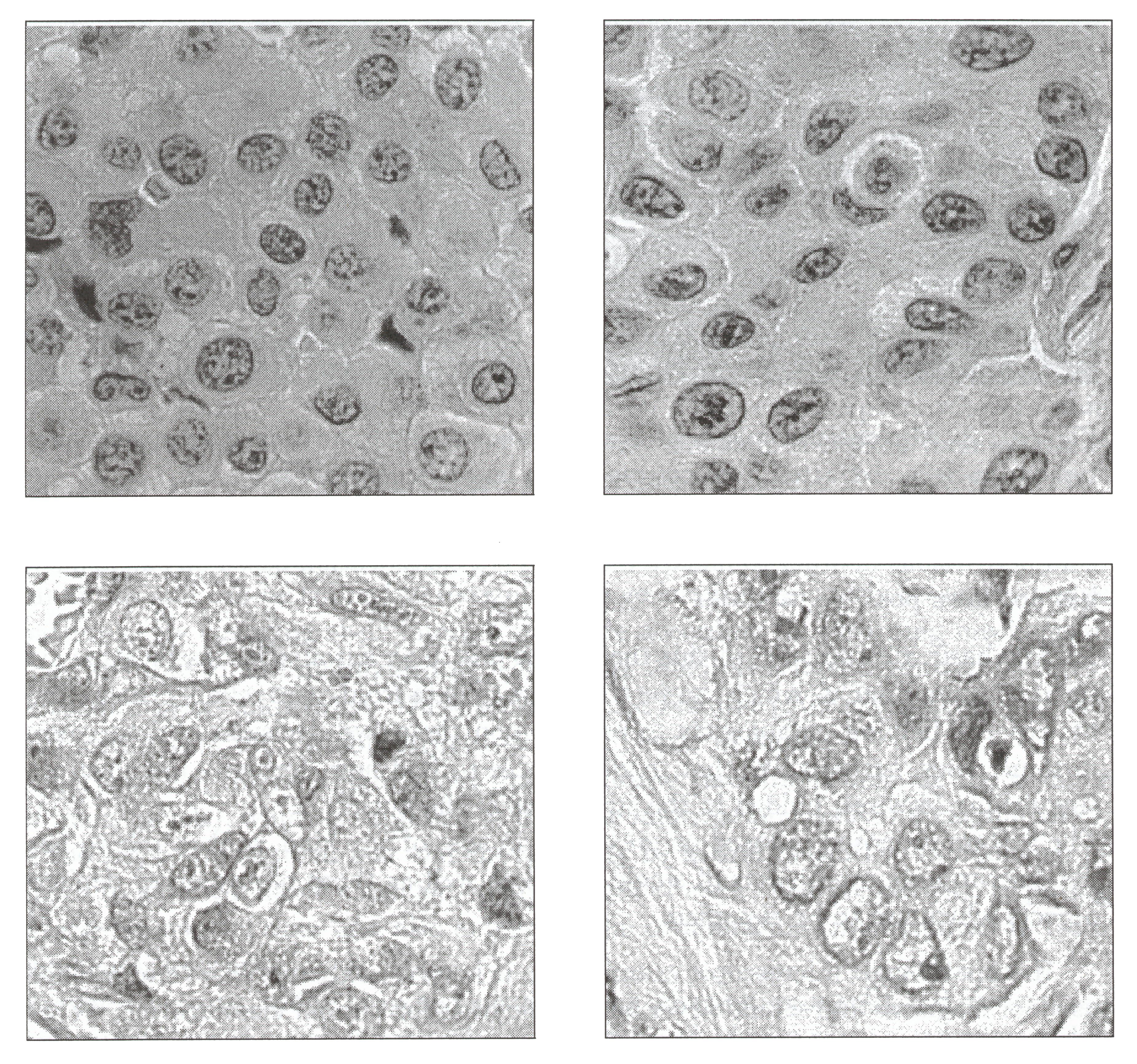 Blog-17-3_KI-u-IdM_Mesotheliom-Adenocarcinom_2020-08-27